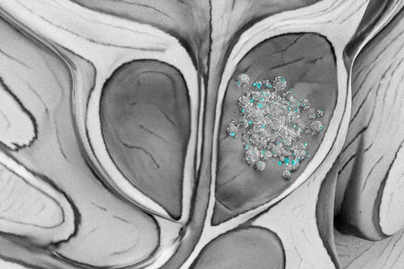 Microplásticos hallados en nueve de cada diez muestras de cáncer de próstata en un estudio piloto
